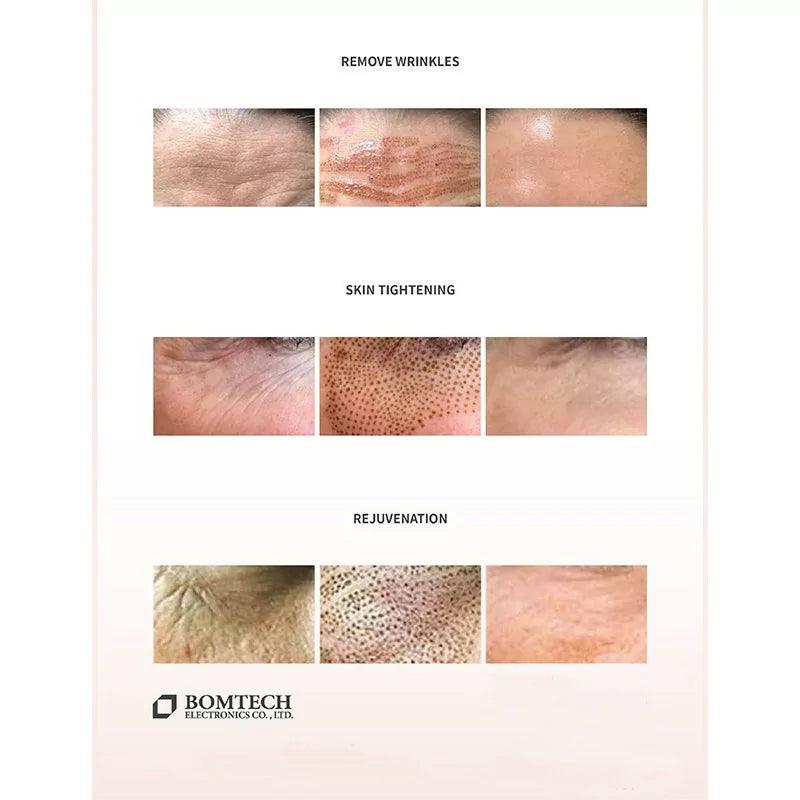 BOMTECH Renouveau Plasma Pen - BVShop