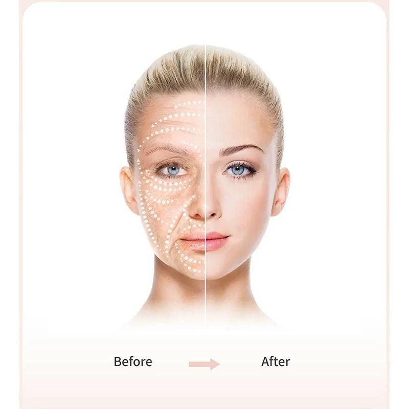 BOMTECH Renouveau Plasma Pen - BVShop